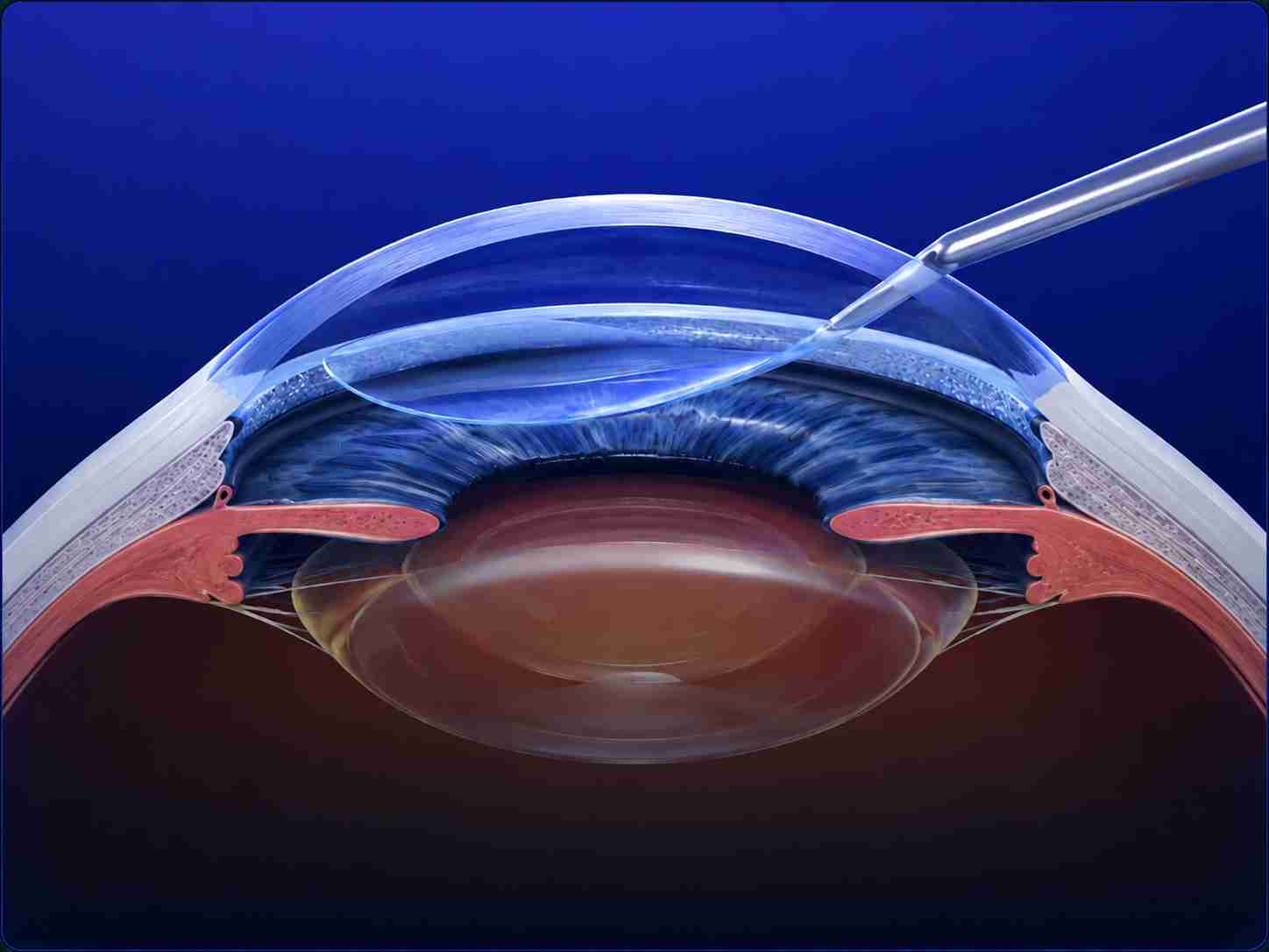 web_DMEK / DSAEK Surgery