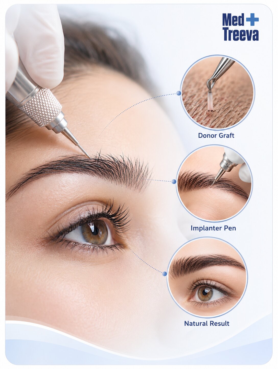 web_Eyebrow Transplant Procedure