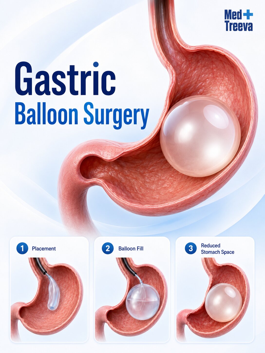 web_Gastric Balloon Surgery