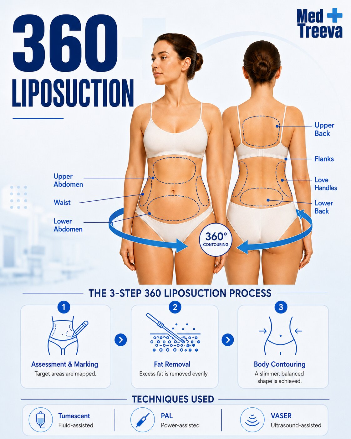 web_Step-by-Step 360 Liposuction Procedure