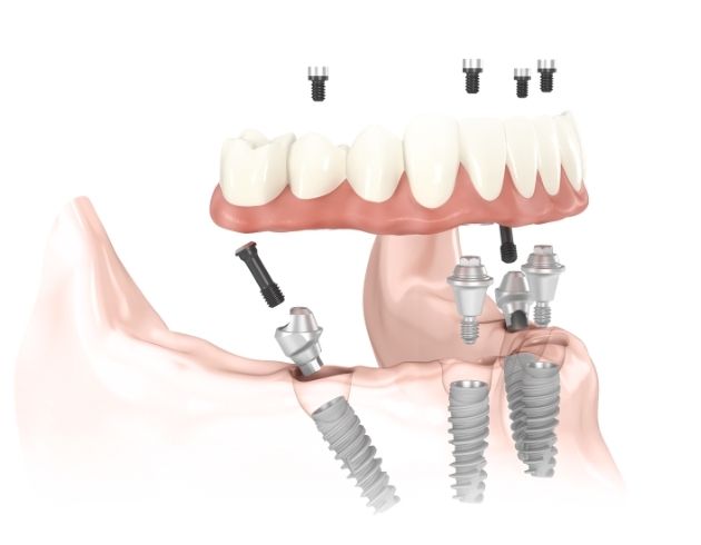 web_Step-by-Step All-on-4 Dental Implant Procedure