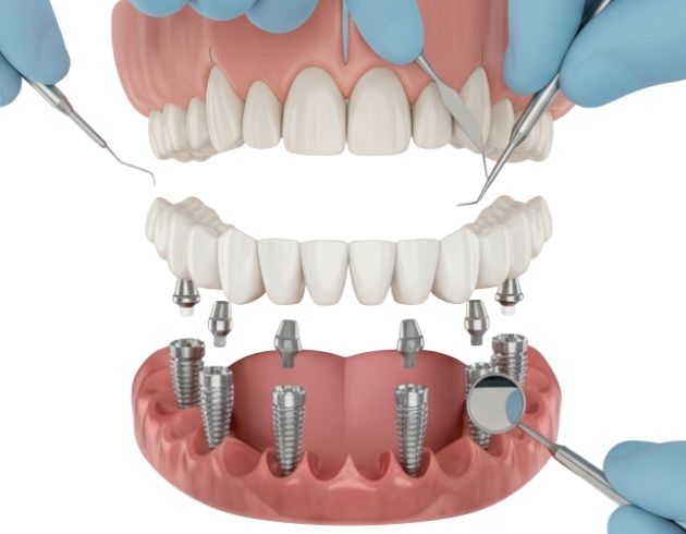 web_Step-by-Step All-on-6 Dental Implant Procedure