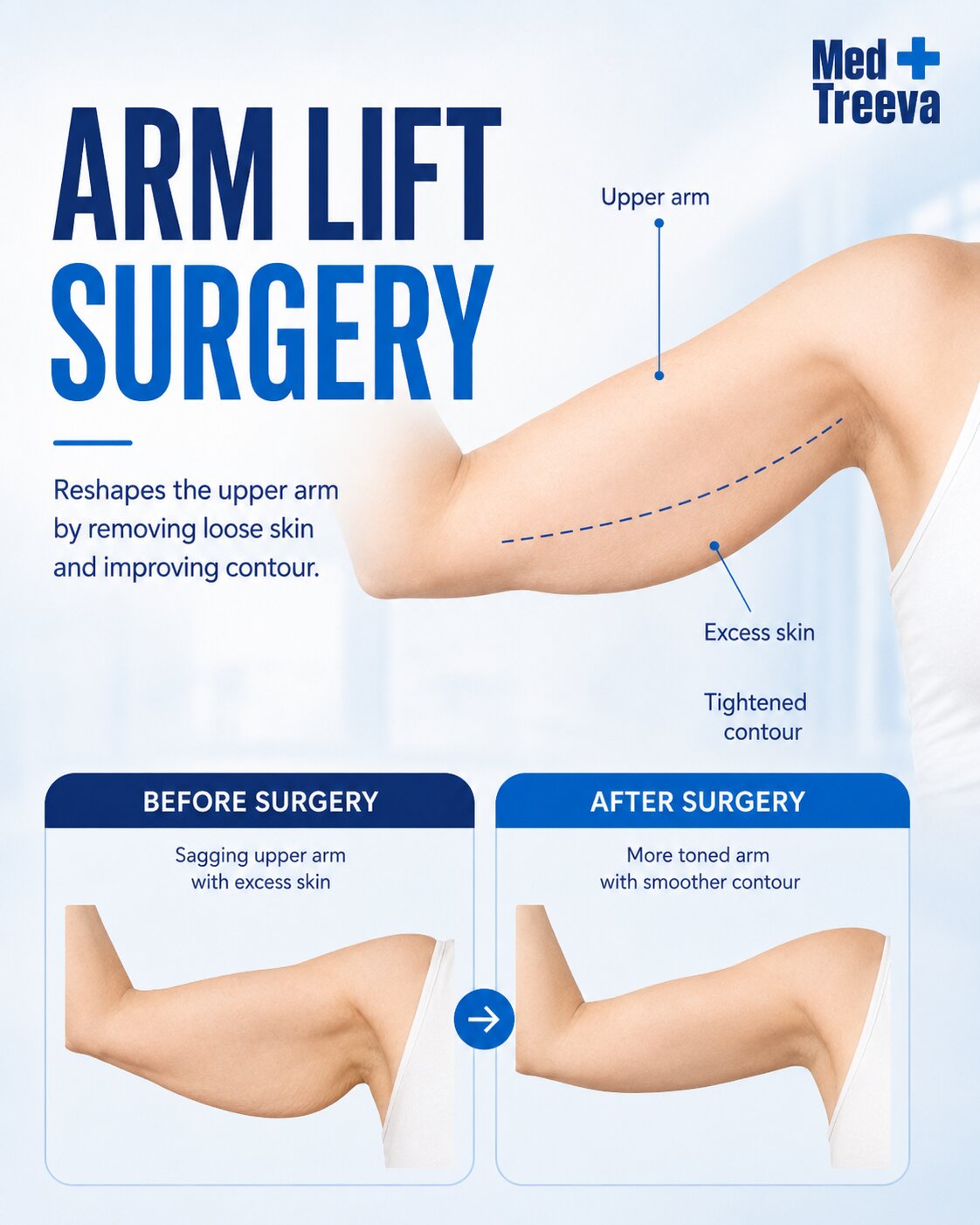 web_Step-by-Step Arm Lift Surgery Procedure