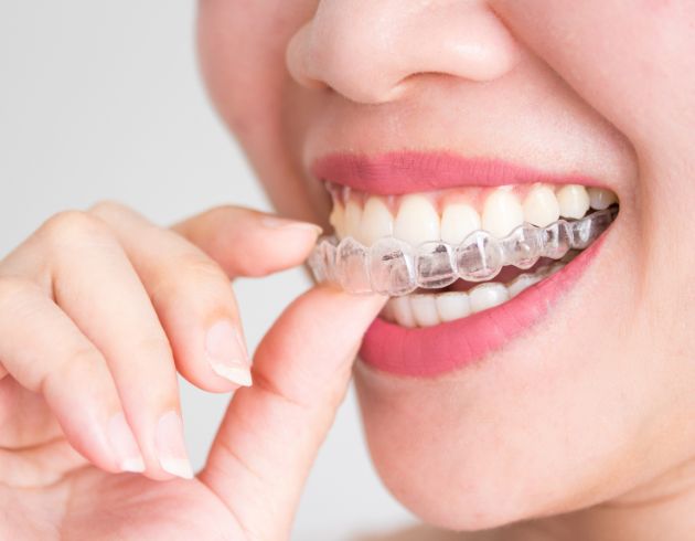 web_Step-by-Step Invisible Braces Treatment