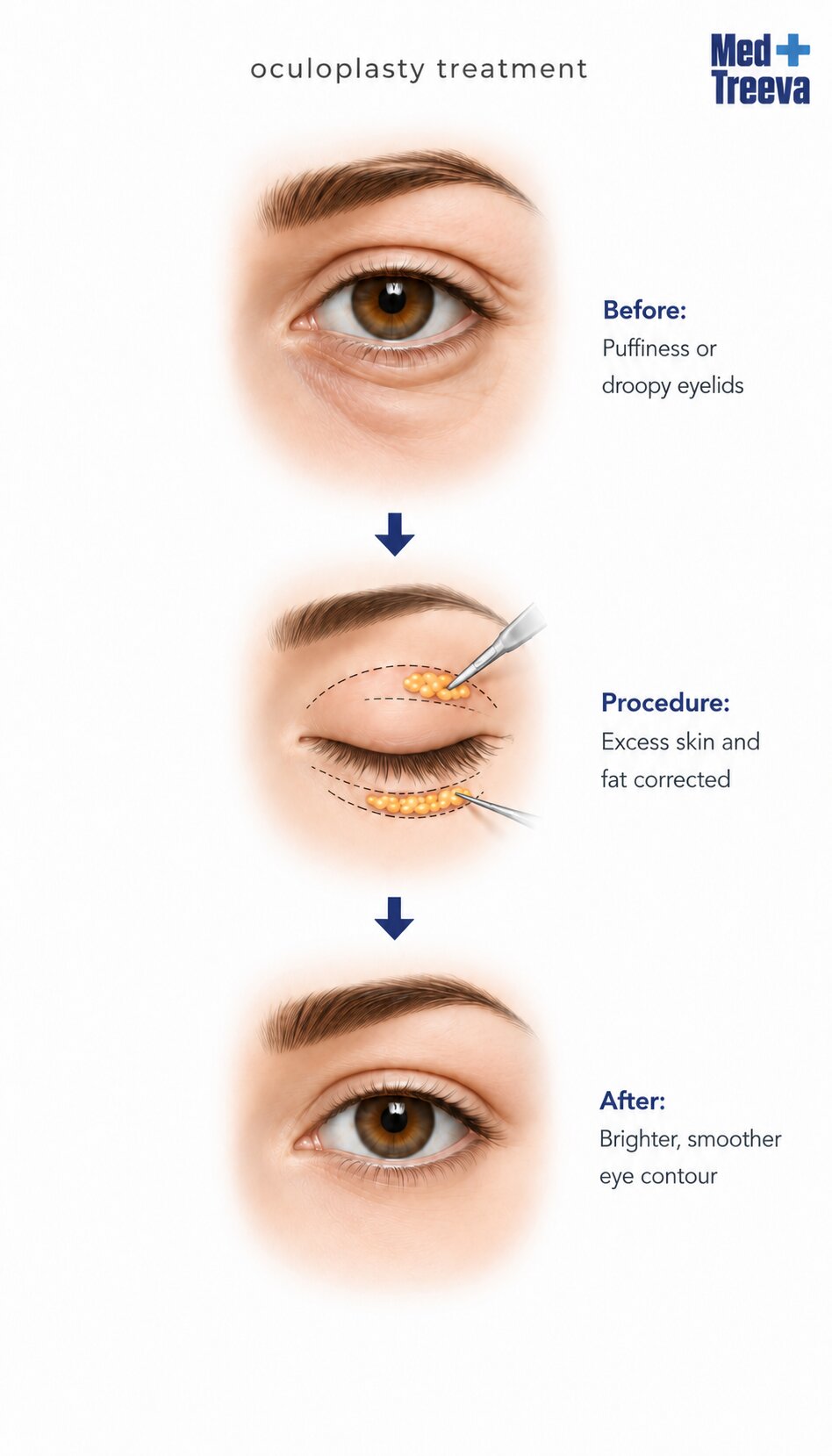 web_Step-by-Step Oculoplasty Treatment Procedure in India