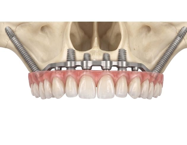 web_Step-by-Step Zygomatic Dental Implant Procedure