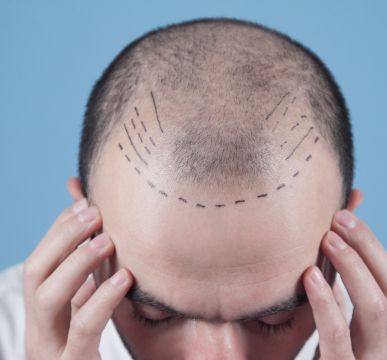 All-Inclusive Hair Transplant Package in India
