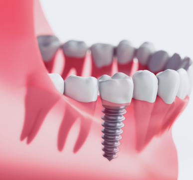 All-Inclusive Immediate Dental Implants Package in India