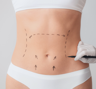 All-Inclusive Tummy Tuck (Abdominoplasty) Package in India